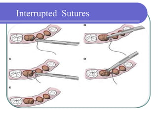 Interrupted Sutures
 