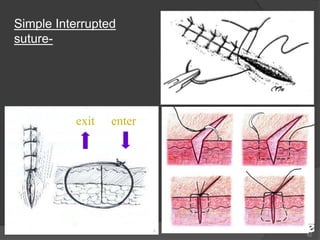 62
enterexit
Simple Interrupted
suture-
 