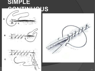 SIMPLE
CONTINUOUS
63
 