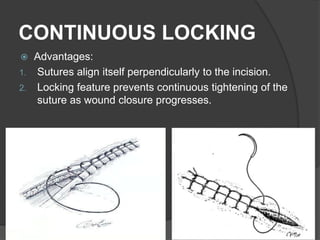 CONTINUOUS LOCKING
 Advantages:
1. Sutures align itself perpendicularly to the incision.
2. Locking feature prevents continuous tightening of the
suture as wound closure progresses.
64
 
