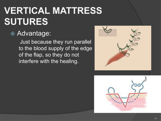 VERTICAL MATTRESS
SUTURES
 Advantage:
Just because they run parallel
to the blood supply of the edge
of the flap, so they do not
interfere with the healing.
68
 
