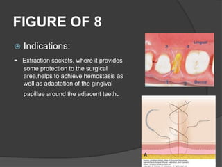 FIGURE OF 8
 Indications:
- Extraction sockets, where it provides
some protection to the surgical
area,helps to achieve hemostasis as
well as adaptation of the gingival
papillae around the adjacent teeth.
69
 