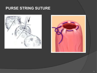 PURSE STRING SUTURE
74
 