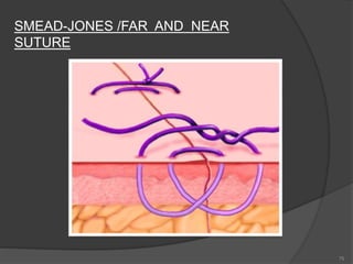 75
SMEAD-JONES /FAR AND NEAR
SUTURE
 