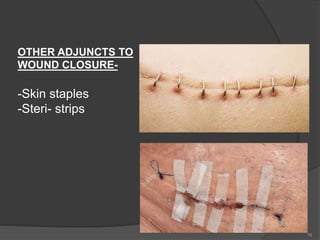 OTHER ADJUNCTS TO
WOUND CLOSURE-
-Skin staples
-Steri- strips
78
 