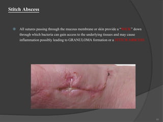  All sutures passing through the mucous membrane or skin provide a “WICK” down
through which bacteria can gain access to the underlying tissues and may cause
inflammation possibly leading to GRANULOMA formation or a STITCH ABSCESS
81
Stitch Abscess
 