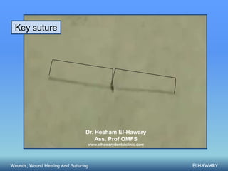 Key suture




                                Dr. Hesham El-Hawary
                                    Ass. Prof OMFS
                                 www.elhawarydentalclinic.com




Wounds, Wound Healing And Suturing                              ELHAWARY
 