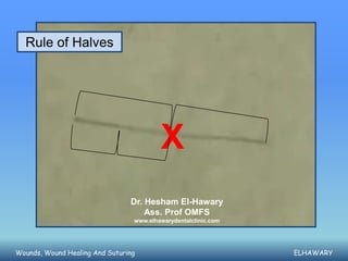 Rule of Halves




                                         X
                                Dr. Hesham El-Hawary
                                    Ass. Prof OMFS
                                 www.elhawarydentalclinic.com




Wounds, Wound Healing And Suturing                              ELHAWARY
 
