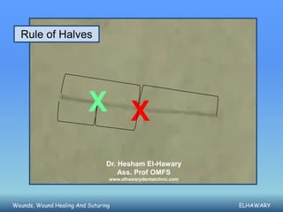 Rule of Halves




                          X X
                                Dr. Hesham El-Hawary
                                    Ass. Prof OMFS
                                 www.elhawarydentalclinic.com




Wounds, Wound Healing And Suturing                              ELHAWARY
 