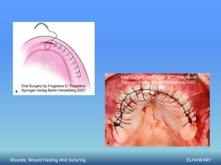 Oral Surgery by Fragiskos D. Fragiskos
                                              Springer-Verlag Berlin Heidelberg 2007
     Oral Surgery by Fragiskos D. Fragiskos
     Springer-Verlag Berlin Heidelberg 2007




Wounds, Wound Healing And Suturing                                             ELHAWARY
 