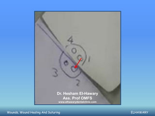 Dr. Hesham El-Hawary
                                    Ass. Prof OMFS
                                 www.elhawarydentalclinic.com



Wounds, Wound Healing And Suturing                              ELHAWARY
 