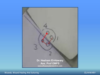 Dr. Hesham El-Hawary
                                    Ass. Prof OMFS
                                 www.elhawarydentalclinic.com



Wounds, Wound Healing And Suturing                              ELHAWARY
 