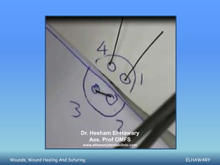 Dr. Hesham El-Hawary
                                    Ass. Prof OMFS
                                 www.elhawarydentalclinic.com



Wounds, Wound Healing And Suturing                              ELHAWARY
 