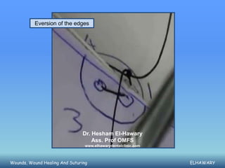 Eversion of the edges




                                Dr. Hesham El-Hawary
                                    Ass. Prof OMFS
                                 www.elhawarydentalclinic.com



Wounds, Wound Healing And Suturing                              ELHAWARY
 