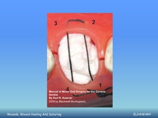 Manual of Minor Oral Surgery for the General
                          Dentist
                          By Karl R. Koerner
                          2006 by Blackwell Munksgaard,



Wounds, Wound Healing And Suturing                                       ELHAWARY
 
