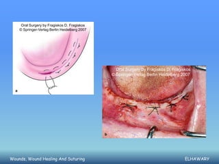 Oral Surgery by Fragiskos D. Fragiskos
    © Springer-Verlag Berlin Heidelberg 2007




                                                 Oral Surgery by Fragiskos D. Fragiskos
                                               © Springer-Verlag Berlin Heidelberg 2007




Wounds, Wound Healing And Suturing                                                  ELHAWARY
 
