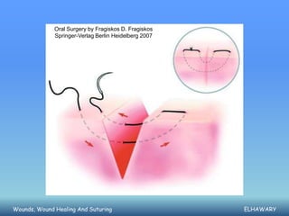 Oral Surgery by Fragiskos D. Fragiskos
              Springer-Verlag Berlin Heidelberg 2007




Wounds, Wound Healing And Suturing                     ELHAWARY
 
