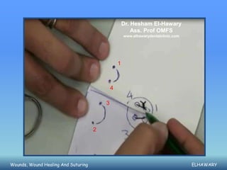 Dr. Hesham El-Hawary
                                                         Ass. Prof OMFS
                                                     www.elhawarydentalclinic.com




                                                 1



                                             4

                                         3



                                     2




Wounds, Wound Healing And Suturing                                                  ELHAWARY
 