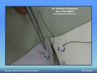 Dr. Hesham El-Hawary
                                             Ass. Prof OMFS
                                         www.elhawarydentalclinic.com




                                                       1




                                     2




Wounds, Wound Healing And Suturing                                      ELHAWARY
 