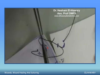 Dr. Hesham El-Hawary
                                             Ass. Prof OMFS
                                         www.elhawarydentalclinic.com




                                     3




Wounds, Wound Healing And Suturing                                      ELHAWARY
 