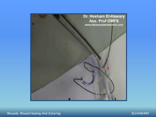 Dr. Hesham El-Hawary
                                         Ass. Prof OMFS
                                     www.elhawarydentalclinic.com




                                                     4




Wounds, Wound Healing And Suturing                                  ELHAWARY
 