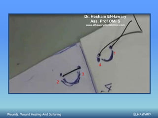 Dr. Hesham El-Hawary
                                             Ass. Prof OMFS
                                         www.elhawarydentalclinic.com




                                                            1

                                                  4

                                     3

                               2




Wounds, Wound Healing And Suturing                                      ELHAWARY
 