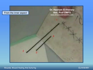 Dr. Hesham El-Hawary
From the inner aspect                    Ass. Prof OMFS
                                     www.elhawarydentalclinic.com


                                           1




                                       4




                   2
                                 3




Wounds, Wound Healing And Suturing                                  ELHAWARY
 