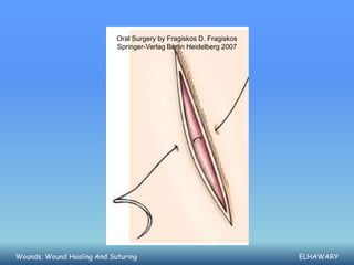 Oral Surgery by Fragiskos D. Fragiskos
                            Springer-Verlag Berlin Heidelberg 2007




Wounds, Wound Healing And Suturing                                   ELHAWARY
 