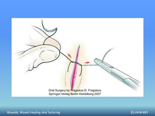 Oral Surgery by Fragiskos D. Fragiskos
                          Springer-Verlag Berlin Heidelberg 2007




Wounds, Wound Healing And Suturing                                 ELHAWARY
 