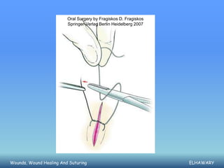 Oral Surgery by Fragiskos D. Fragiskos
                         Springer-Verlag Berlin Heidelberg 2007




Wounds, Wound Healing And Suturing                                ELHAWARY
 