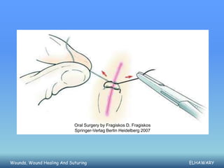 Oral Surgery by Fragiskos D. Fragiskos
                            Springer-Verlag Berlin Heidelberg 2007




Wounds, Wound Healing And Suturing                                   ELHAWARY
 