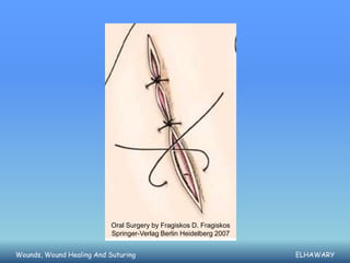 Oral Surgery by Fragiskos D. Fragiskos
                           Springer-Verlag Berlin Heidelberg 2007


Wounds, Wound Healing And Suturing                                  ELHAWARY
 