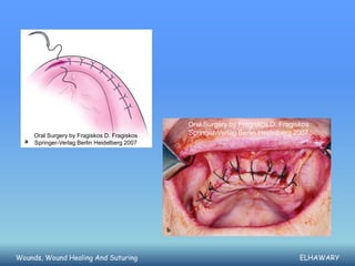 Oral Surgery by Fragiskos D. Fragiskos
     Oral Surgery by Fragiskos D. Fragiskos   Springer-Verlag Berlin Heidelberg 2007
     Springer-Verlag Berlin Heidelberg 2007




Wounds, Wound Healing And Suturing                                               ELHAWARY
 