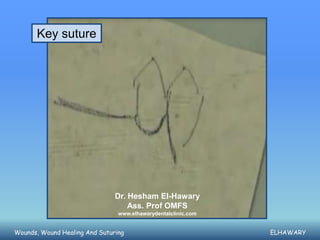 Key suture




                               Dr. Hesham El-Hawary
                                   Ass. Prof OMFS
                                www.elhawarydentalclinic.com


Wounds, Wound Healing And Suturing                             ELHAWARY
 