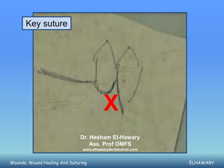 Key suture




                                          X
                               Dr. Hesham El-Hawary
                                   Ass. Prof OMFS
                                www.elhawarydentalclinic.com


Wounds, Wound Healing And Suturing                             ELHAWARY
 