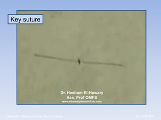 Key suture




                                Dr. Hesham El-Hawary
                                    Ass. Prof OMFS
                                 www.elhawarydentalclinic.com




Wounds, Wound Healing And Suturing                              ELHAWARY
 