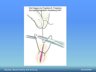 Oral Surgery by Fragiskos D. Fragiskos
                         Springer-Verlag Berlin Heidelberg 2007




Wounds, Wound H...