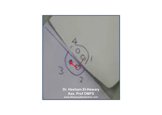 Dr. Hesham El-Hawary
                                    Ass. Prof OMFS
                                 www.elhawarydenta...