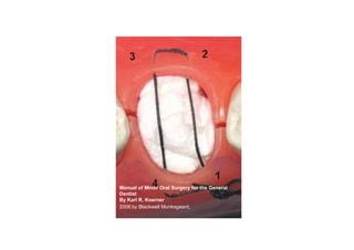 Manual of Minor Oral Surgery for the General
                          Dentist
                          By Karl R. Koerne...