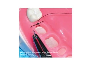 Manual of Minor Oral Surgery for the General Dentist
            By Karl R. Koerner
            2006 by Blackwell Munksgaa...