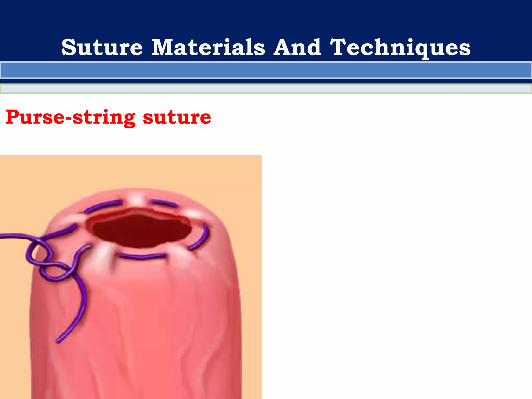 Suturing technique | PDF