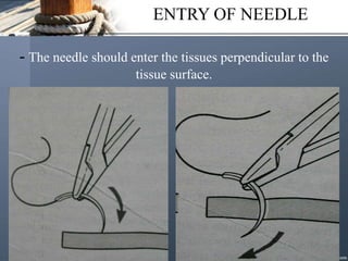 ENTRY OF NEEDLE
- The needle should enter the tissues perpendicular to the
tissue surface.
 