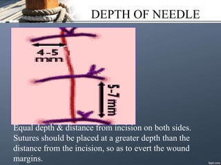 DEPTH OF NEEDLE
Equal depth & distance from incision on both sides.
Sutures should be placed at a greater depth than the
distance from the incision, so as to evert the wound
margins.
 