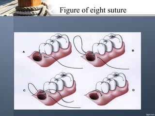 Figure of eight suture
 