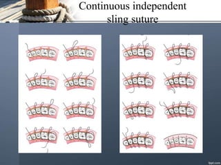 Continuous independent
sling suture
 