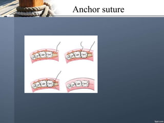 Anchor suture
 