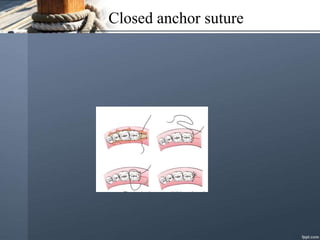 Closed anchor suture
 