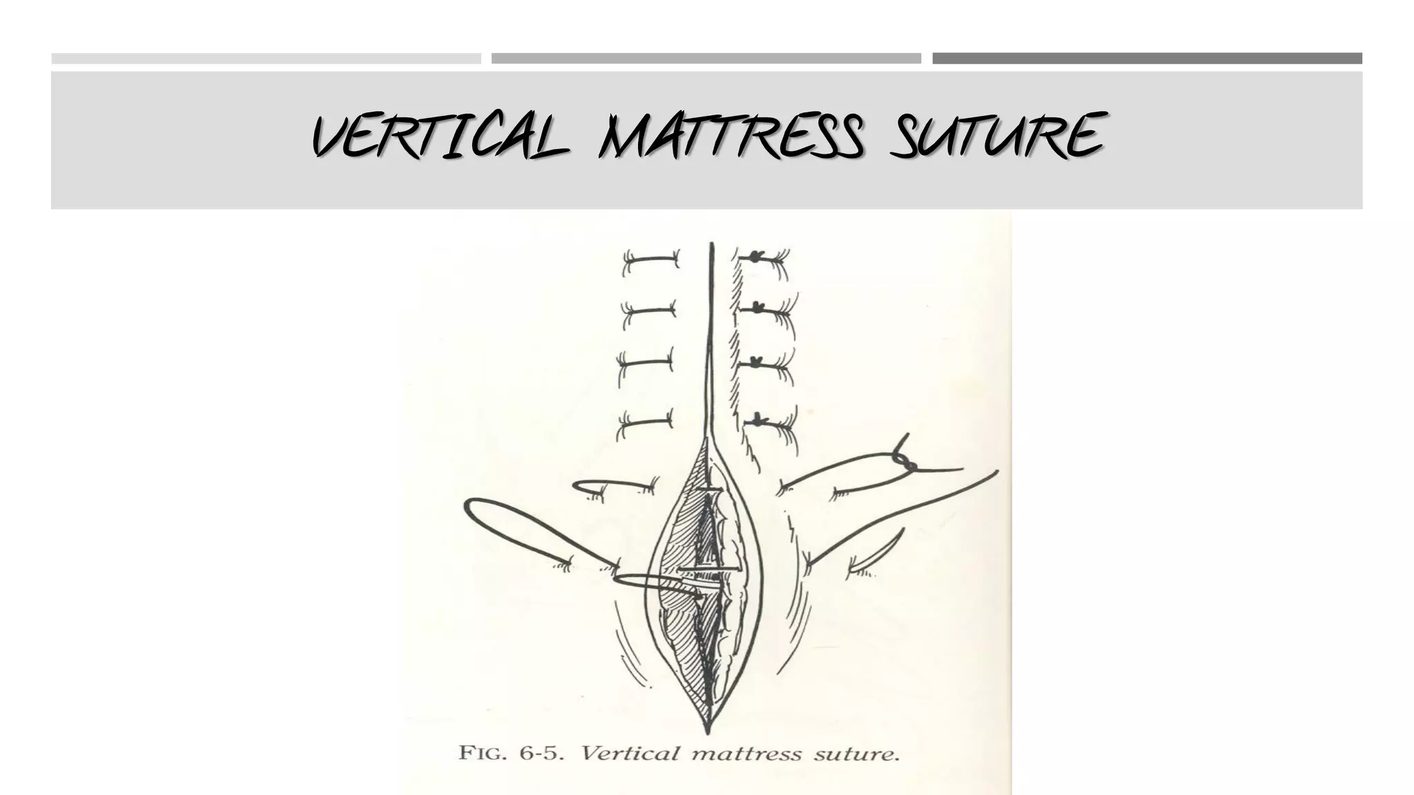 Suturing Techniques | PDF