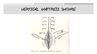 VERTICAL MATTRESS SUTURE
 