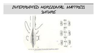 INTERRUPTED HORIZONTAL MATTRESS
SUTURE
 